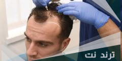مراكز زراعة الشعر في السعودية معلومات مفصلة عن العملية