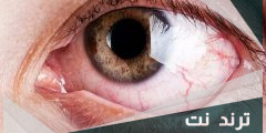 لماذا تدمع العين بدون سبب